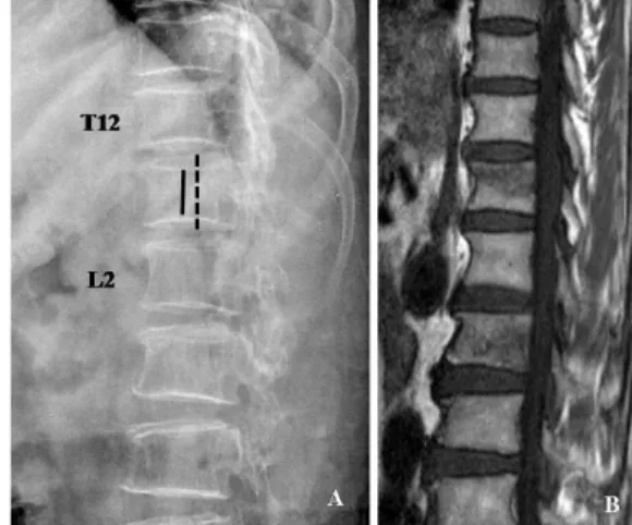 Fig.  8.  A  77-  year-  old  women  with  occult  osteoporotic  vertebral  fractures  of  L1  (A),  confirmed  by  MRI  (B)