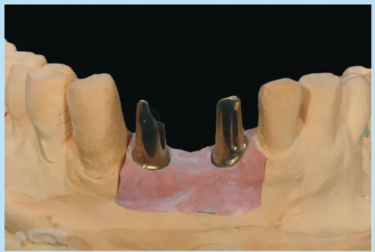 Fig. 2. 	Matured	peri-implant	soft	tissue	structure	after	2nd	 surgery.