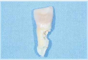 Fig. 2. 	Extracted	right	maxilla	central	incisor	(#21),	severe	 external	root	resorption	extended	to	cementum,	dentin	and	 pulp	canal	can	be	seen.