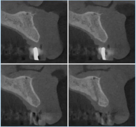 Fig.  4. 	 Cone-beam	 computed	 tomography,	cross-sectional	view	at	 the	 implant	 placement	 site	 (#21,	 maxilla	left	central	incisor).