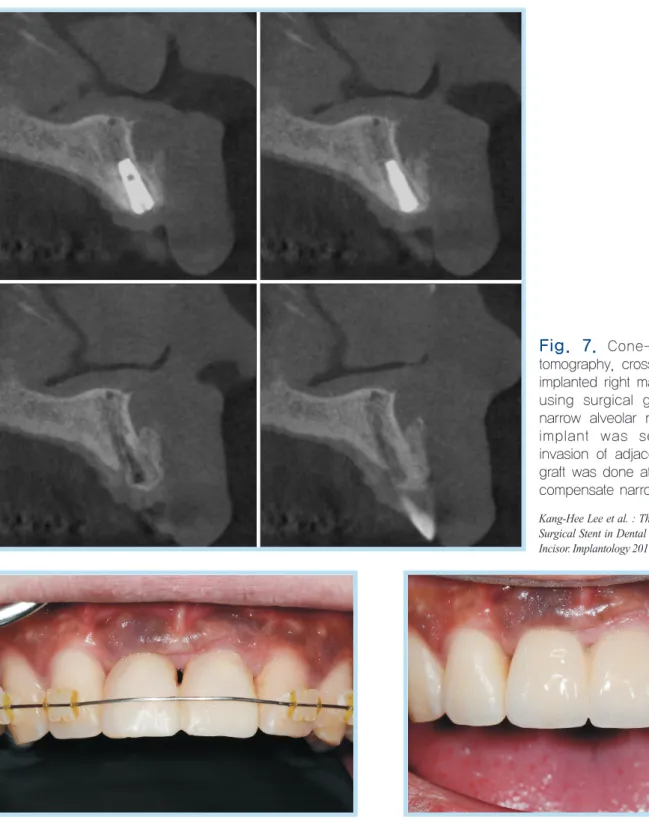 Fig. 9. 	After	gingival	molding,	gingival	impression	taking	 and	Installation	of	the	custom	abutment	and	porcelain	 fused	zirconia	crown	was	done.	The	black	triangle	was	 successfully	filled,	and	symmetrical	marginal	gingiva	was	 achieved.	At	the	upper	att