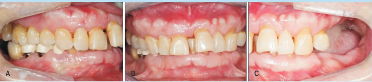 Fig. 3. 	Reverse	curve	of	Spee	and	inadequate	occlusal	 plane	of	mandibular	dentition.