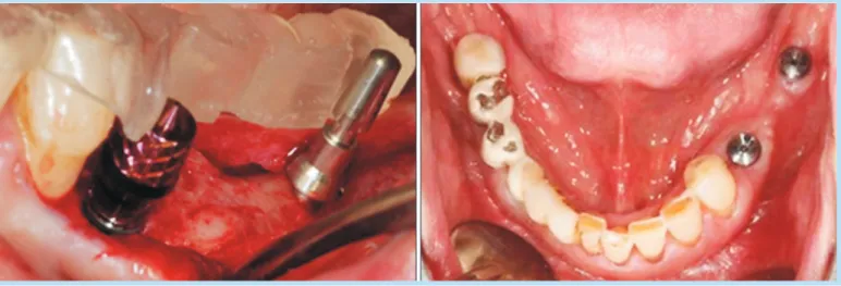 Fig. 7. 	(A)	Impression	for	mandible.	(B)	First	provisonal	restoration	considering	increased	vertical	dimension.