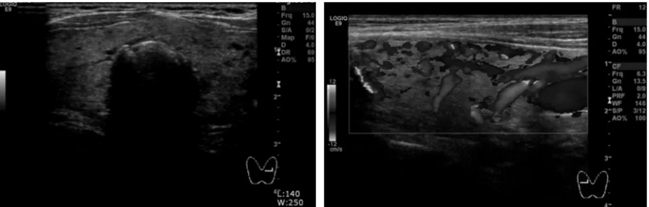 Fig.  3.  Thyroid  sonographic  findings  showed  thyroid  gland’s  diffuse  enlargement  with  inhomogeneous  echogenecity