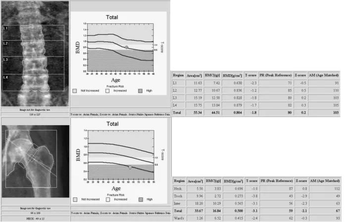 Fig.  4.  99mTC-sestamibi  scan  showed  no  focal  parathyroid  uptake  on  2-hour  delayed  image.