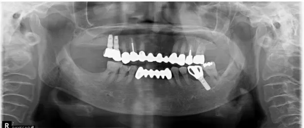 Fig. 1. Panorama x-ray imaging at the first examination. Extraction of the left maxillary first molar and  implant  placement  were  scheduled  because  of  patient’s  discomfort  due  to  recurrent  caries  and  periapical lesion