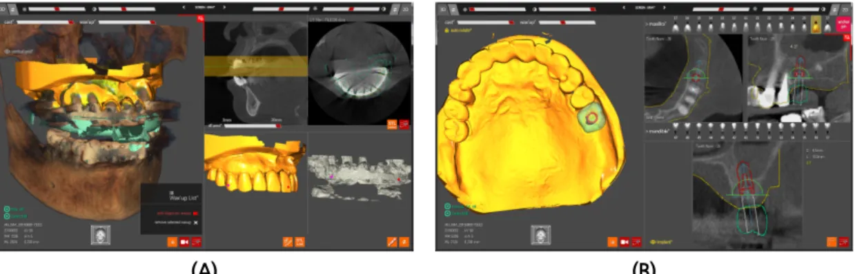 Fig. 4. (A) Superimposition process with CBCT using outline of radiographic guide tray of combination  scan data