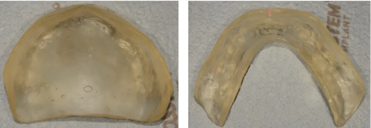Fig. 4. Upper and lower temporary dentures were duplicated with acrylic resin to use as a custom tray.