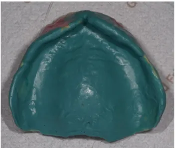 Fig.  8.  Relining  impression  of  the  maxillary  complete  wax  denture  with  the  polyether  impression  material (closed-mouth technique with an occlusal interdigitation).