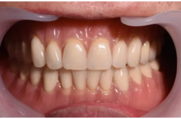 Fig. 12. The definitive denture was placed in the oral cavity.