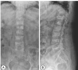 Fig.  5.  (A)  AP  radiography  after  vertebroplasty.  (B)  Late- Late-ral  radiography  after  vertebroplasty