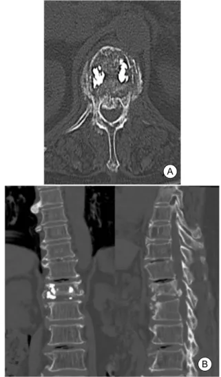 Fig.  1.  The  72  years  old  women  who  had  previous  under- under-gone  vertebroplasty  on  T12  (arrow)  in  lumbar  simple  X-ray,  AP  (A)  and  lateral  view  (B).