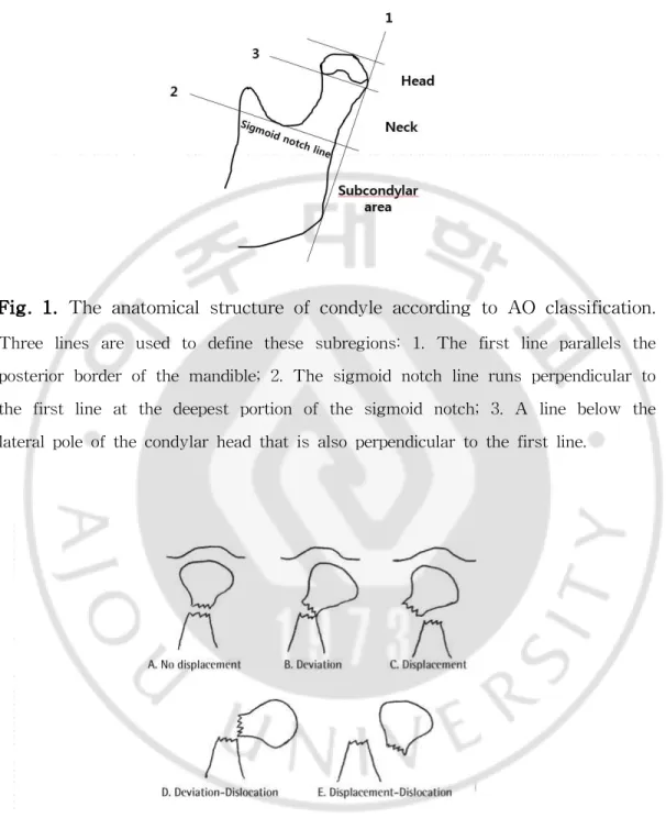 Fig. 1. The anatomical structure of condyle according to AO classification. Three lines are used to define these subregions: 1