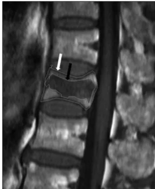 Fig.  1.  Measurement  of  anterior  wedge  angle  (AWA). 