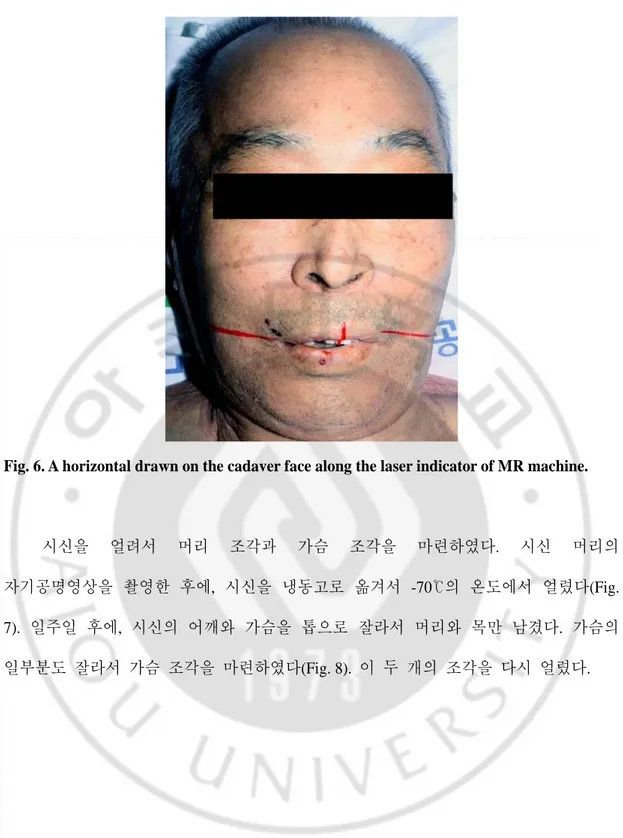 Fig. 6. A horizontal drawn on the cadaver face along the laser indicator of MR machine