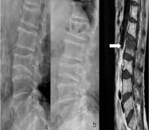 Fig.  1.  The  78  years  old  women  who  had  previous  old  L3  compression  fracture  (a)  developed  new  L2  compression  fracture  (b)  in  lumbar  spine  lateral  x-ray  view  and  MRI  (T1-weighted  image)  showed  compression  fracture  of  L2  w
