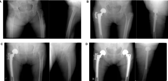 Fig.  1. 69-year  old  woman  had  a  subsequent  fracture  in  the  left  side  after  right  side  intertrochanteric  fracture  (initial  T-score  -5.3)