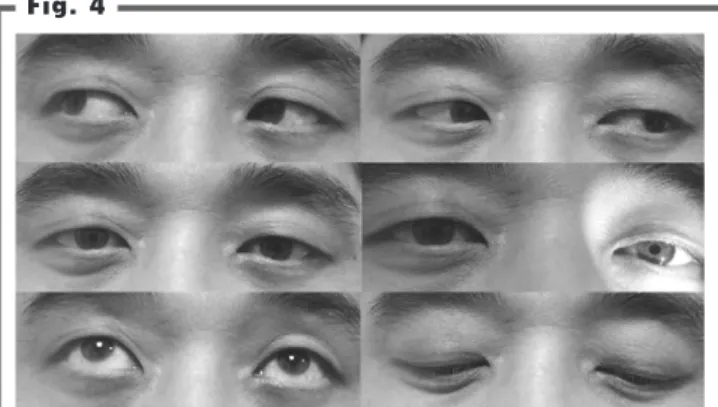 Fig. 3 Ptosis (+) Ophthalmoplegia LR (-) Ptosis (-) Diplopia (-) Accommodation (±)OpTime course