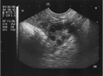 Figure 2. About 16×12 mm sized echogenic nodule is  seen on just outer aspect of right uterine cornus with  surrounding fluid collection