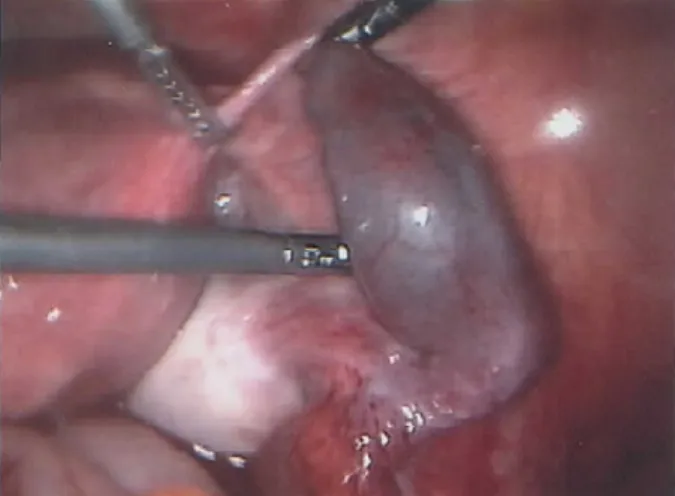 Figure 5. Operating findings of laparoscopic right  salpingectomy and left salpingostomy