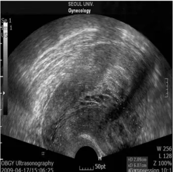 Figure 3. Transvaginal ultrasonographic image shows  the normal finding of endometrium (hysteroscopic  polypectomy after 4 months) 