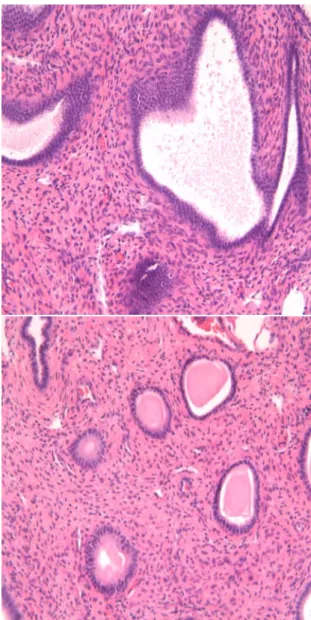 Figure 5. Microscopic finding of  endometrial polyp  (H&amp;E stain, ×200): The section shows variable-sized  and some cystically dilated glands within a dense  fibrovascular stroma with periglandular condensation