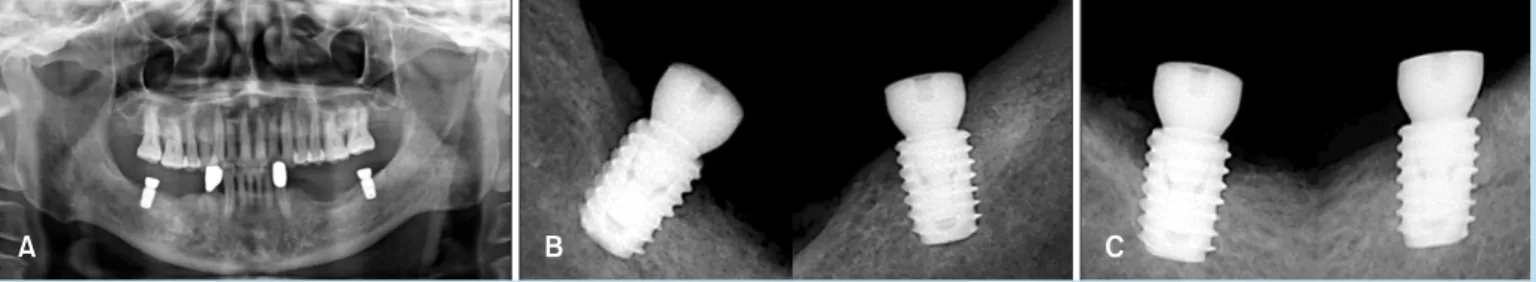 Fig. 1. 	Implant-supported	removable	partial	denture	case. 20 	(A)	Panoramic	X-ray	after	implant	placement.	(B)	Periapical	view	 5	months	after	implant	placement	and	before	the	final	denture	delivery.	(C)	Periapical	X-ray	after	35	months	after	implant	 ins