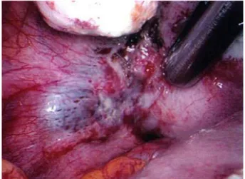 Figure 1. Transvaginal ultrasonogram showing a