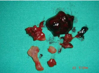 Figure 4. Gross finding of ectopic mass. Some blood  clots and trophoblastic tissues were noted