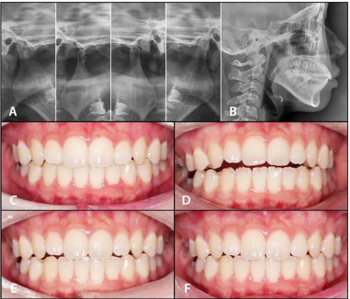 Fig. 8. 이갈이 및 골관절염 소견으로 교합안정장치 치료 이후 개방교합이 발생하여 악간견인장치로 교체하여 치료한 증례(자료제 공: 경북대학교 치과병원 구강내과) A