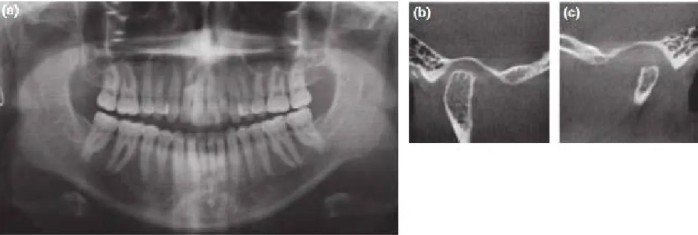 Fig. 6. 왼쪽 하악과두의 형성부전(hypoplasia) 8) . (a) 파노라마 사진, (b, c) CBCT 사진, 정상적인 오른쪽 과두(b)와 작은 왼쪽 과두(c)