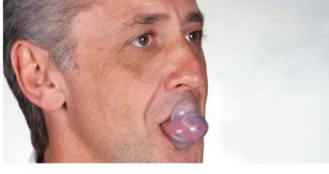 그림 2. aveoTSD ® (Tongue Stabilizing Device) https://www.aveotsd.com/