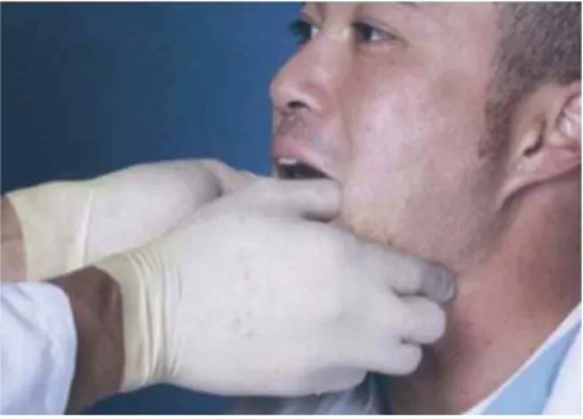 Fig. 1. Conventional reduction technique for TMJ distocation reduction.