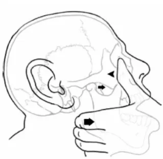 Fig. 3은 Chen method에서 탈구된 이환측의 술자의 손의 위치를 나타내는 그림이다. 술자의 엄지는 구강 내로 접근하여, 탈구된 하악골의 오훼돌기에 위치시 키고, 나머지 손가락은 구외로 환자의 유양돌기 부위 에 위치 시킨다