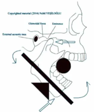Fig. 5. 이환측 구치부에 10cc 시린지와 같은 실린더 모양의 물체를 올린 후, 환자에게 시린지가 빠지지 않게 최 대한 노력으로 시린지를 구치부 치아들로 catch시킨 후, 전후방으로 움직이도록 유도하는 방법