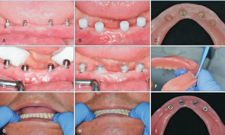 Fig. 7.  Indirect technique of attachment incorporation. (A) Eight weeks after implant insertion