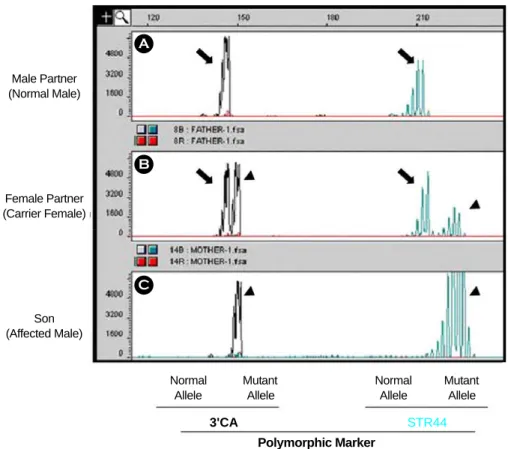 Figure 1. Electropherogram of  the dinucleotide repeat analysis for genetic diagnosis of  Duchenne muscular dystrophy.