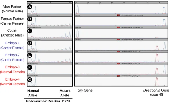 Figure 3. Electropherogram of  the dinucleotide repeat marker (DYSI) analysis, Sry, and dystrophin exon 45 for pre- pre-implantation genetic diagnosis of Duchenne muscular dystrophy in case 3