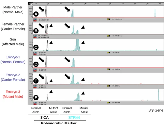 Figure 4. Electropherogram of  the dinucleotide repeat markers (3'CA and STR44) analysis and Sry for preimplan- preimplan-tation genetic diagnosis of  Duchenne muscular dystrophy in case 4