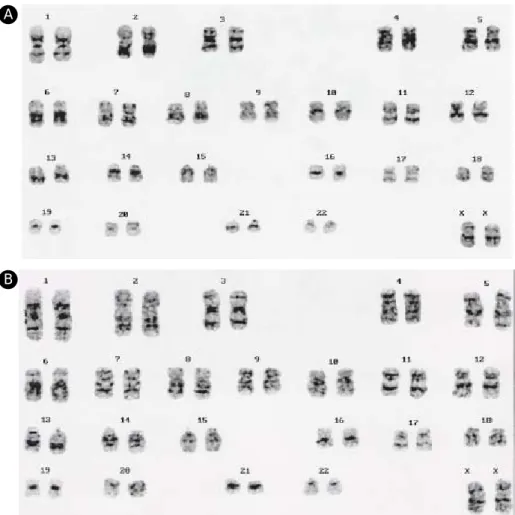Figure 2. Results of karyotyping.(A) SNUhES2 P71-25 on hAFC treated with mitomycin C: 46,XX (B) SNUhES2 P71-25 on hAFC non-treated with mitomycin C: 46,XX 