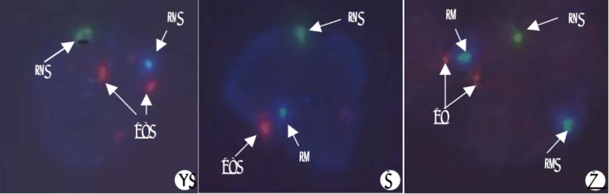 Figure 1. FISH results in the blastomere of  embryos from Klinefelter syndrome by using CEP probe for X (Spectrum Aqua), Y (Spectrum Green) and 18 (Spectrum Orange)