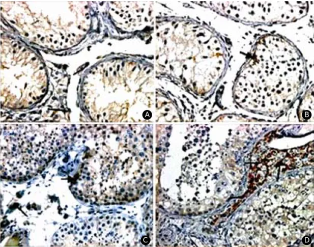 Figure 2. Immunohistochemical stains for VEGF (×400). A; Sertoli cell only syndrome B; maturation arrest C; hypo- hypo-spermatogenesis D; control group Sertoli cell; thick black arrow Leydig cell; thin black arrow