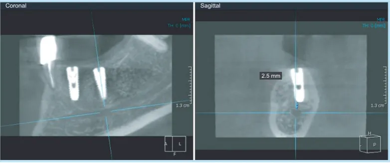 Fig. 3. 	Safety	margin	of	the	mandibular	left	first	molar.