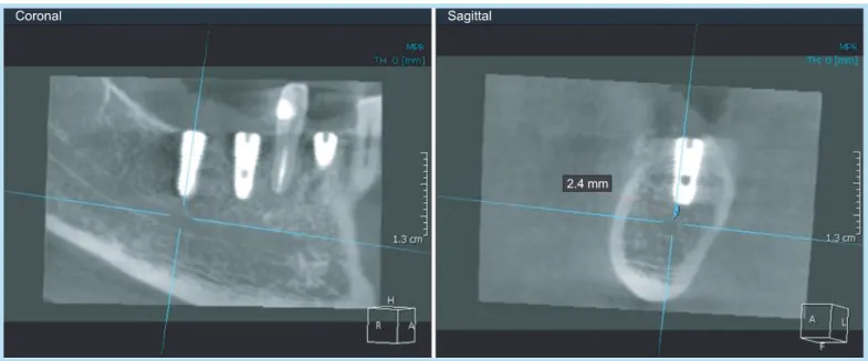 Table 1.  Visual analogue scale (cm) of discomfort  and/or pain during anesthesia and implant placement