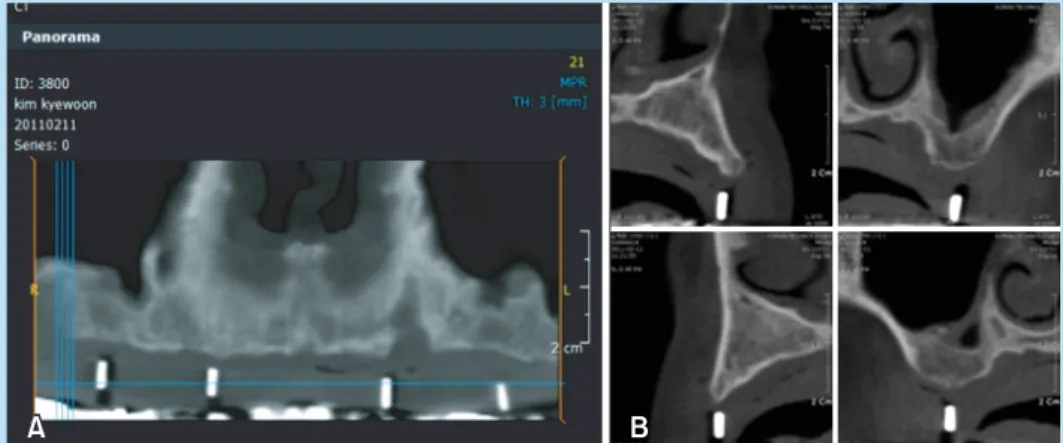Fig. 5.  Bite	registration	(A)	using	framework	of	maxilla	(B).