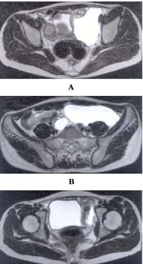 Figure 1a. A segment of right uterine body with  functioning endometrium and  hemato-metra