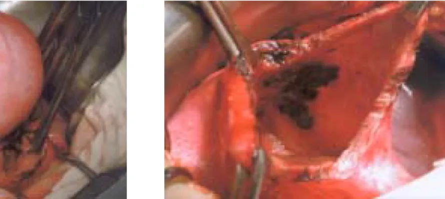 Figure 2. A segment of  right uterine body forming hematometra. 