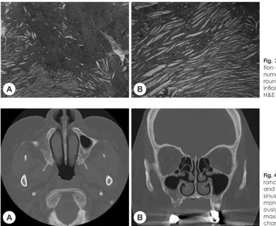 Fig. 3. Histopathological examina- examina-tion of the lesion of demonstrated  numerous cholesterol clefts with  sur-rounding foreign body giant cells,  inflammatory cells (A: H&amp;E ×40, B: 