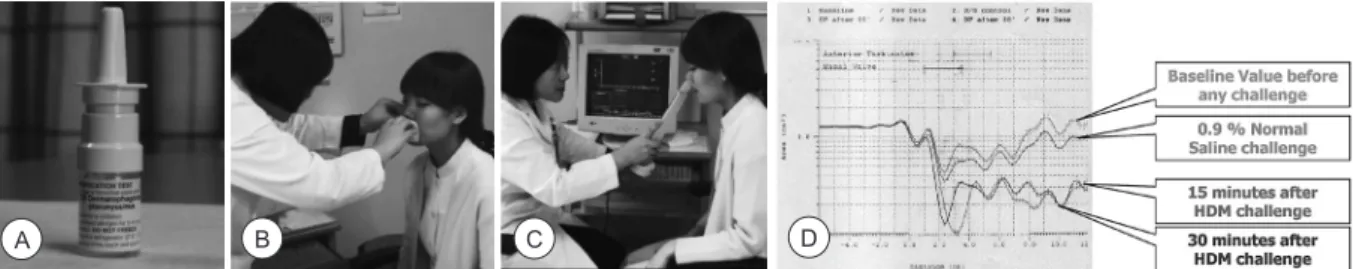 Fig. 1. (A) Allergen extract (Dermatophagiodes pteronyssinus) commercially available for nasal provocation test