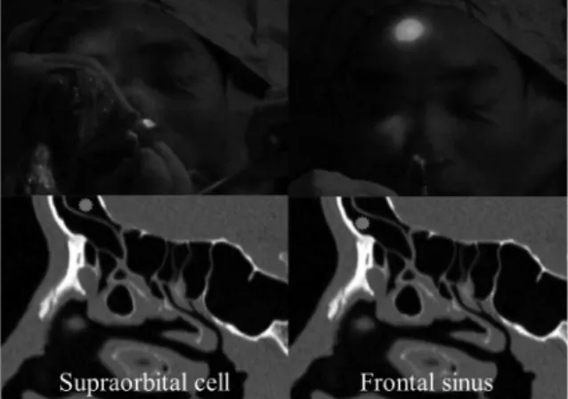 Fig. 2.  Transcutaneous illumination. Different patterns of illumi- illumi-nation according to the position of the guide-wire.